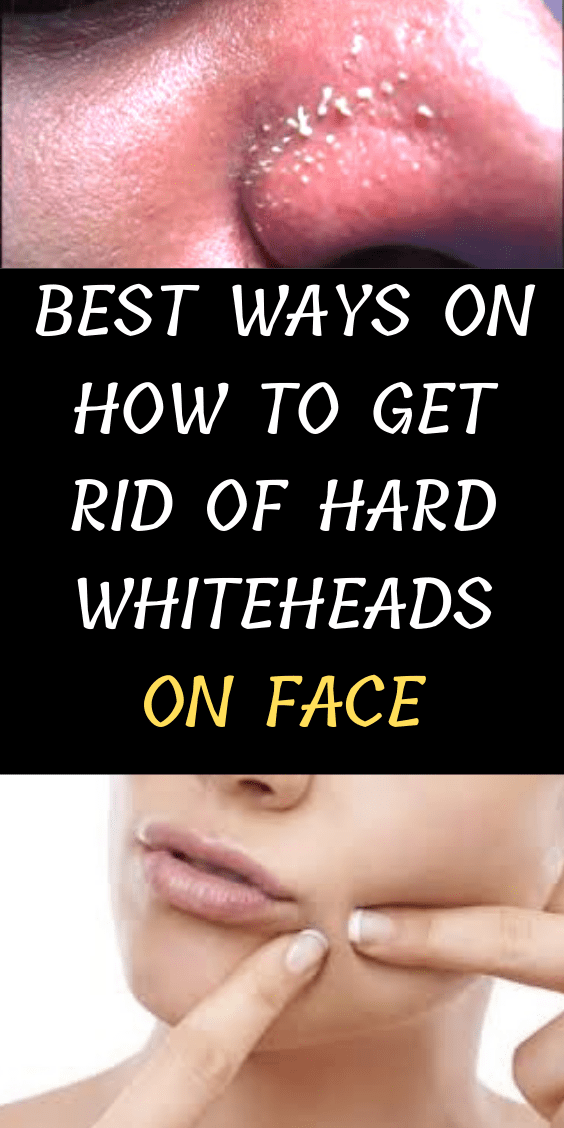 best-ways-on-how-to-get-rid-of-hard-whiteheads-on-face